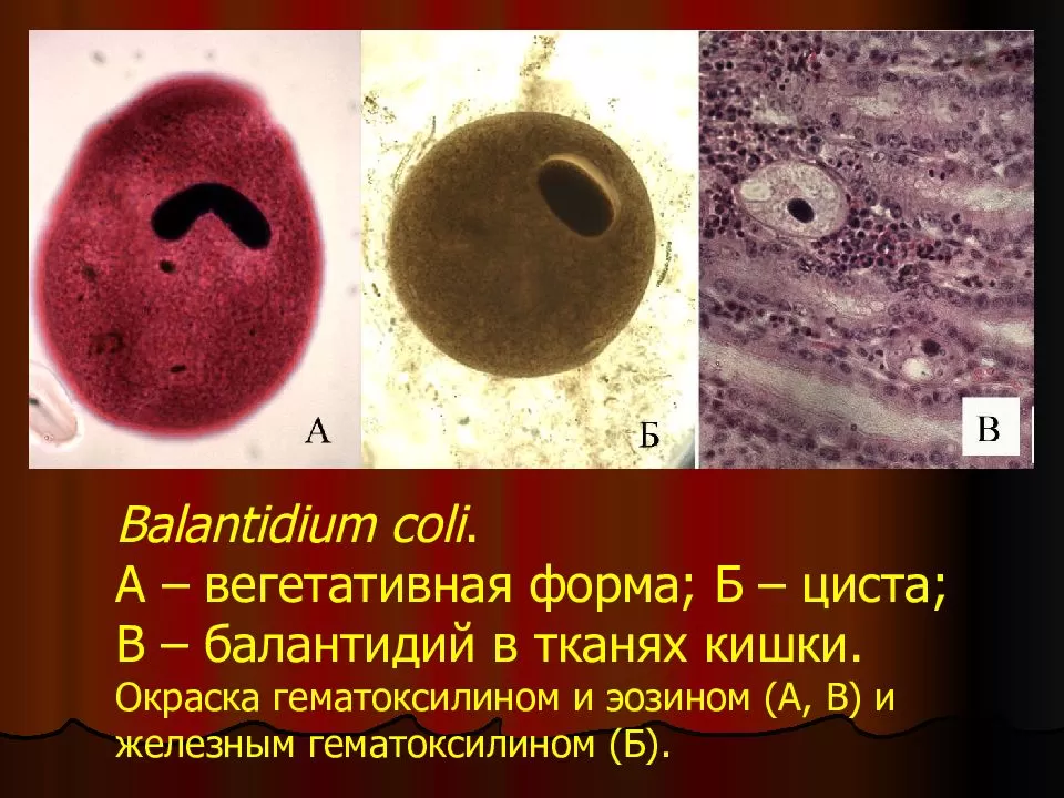 Balantidium lechenie